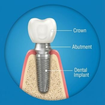 Single Dental Implant